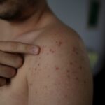 Migrants Linked To 600+ Dangerous Measles Cases In Deep Red State