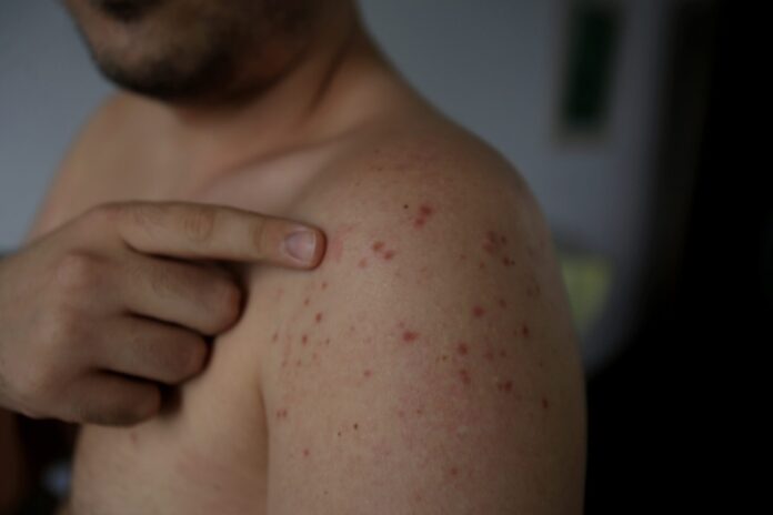 roseola infection